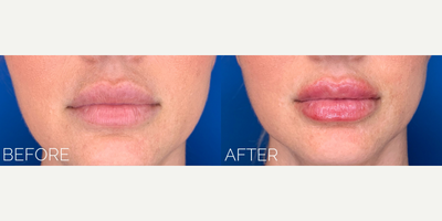 Dermal Fillers before and after photo