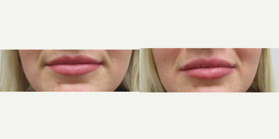 Dermal Fillers before and after photo