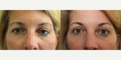Eyelid Surgery before and after photo