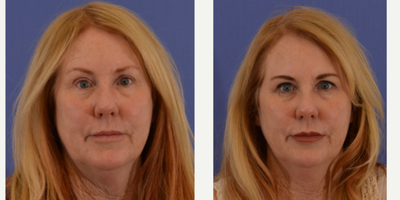 Eyelid Surgery before and after photo