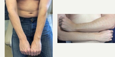 IPL before and after photo
