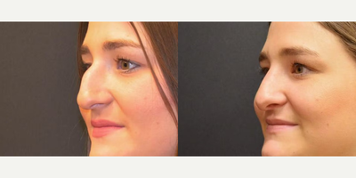 Rhinoplasty before and after photo
