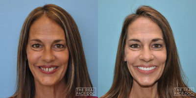All-on-4 Dental Implants before and after photo