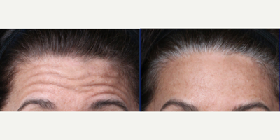 Botox before and after photo
