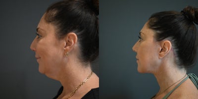 Deep Plane Facelift before and after photo