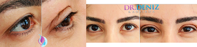 Eyelid Surgery before and after photo