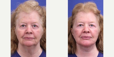 Facelift before and after photo
