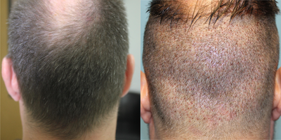 Hair Transplant before and after photo
