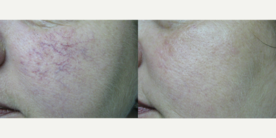 Laser Resurfacing before and after photo