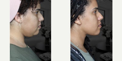 Neck Lift before and after photo