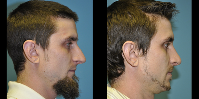 Rhinoplasty before and after photo