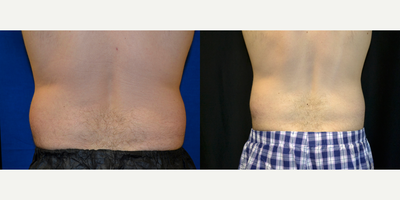 CoolSculpting before and after photo