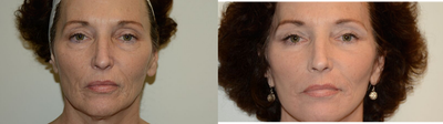Eyelid Surgery before and after photo
