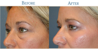 Eyelid Surgery before and after photo