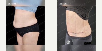 Tummy Tuck before and after photo
