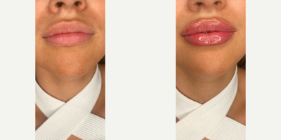 Dermal Fillers before and after photo