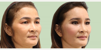 Facelift before and after photo
