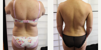 Mommy Makeover before and after photo
