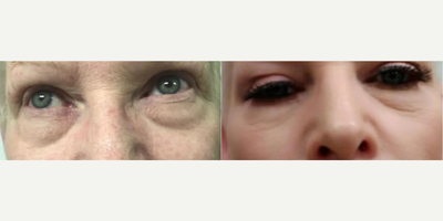 PRP Injections before and after photo