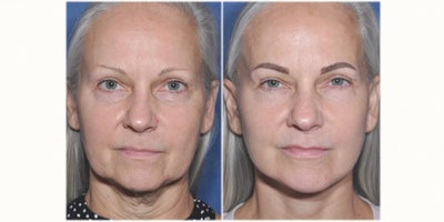 Chin Implant before and after photo