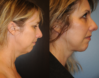 Facelift before and after photo