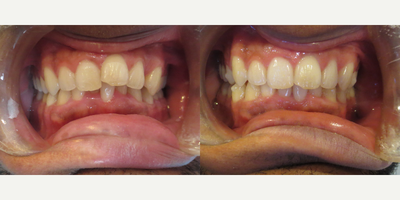 Invisalign before and after photo