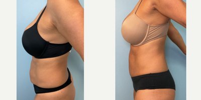 Liposuction before and after photo