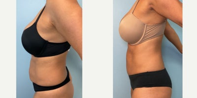 Liposuction before and after photo