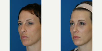 Rhinoplasty before and after photo