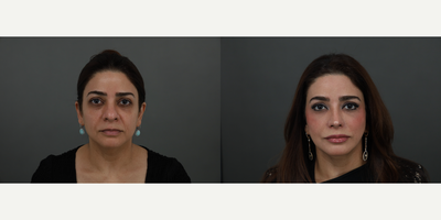 Rhinoplasty before and after photo