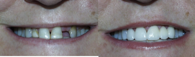 Smile Makeover before and after photo
