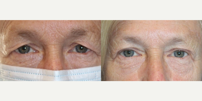 Brow Lift before and after photo