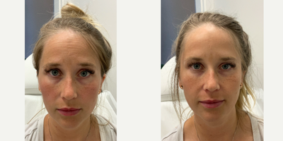Dysport before and after photo