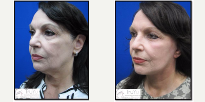 Facelift before and after photo