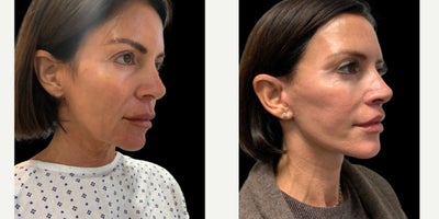 Facelift before and after photo