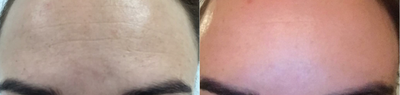Fractional Laser before and after photo