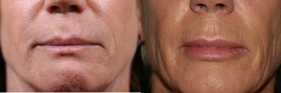 Lip Implants before and after photo