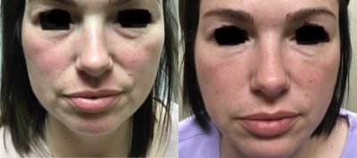 Restylane before and after photo
