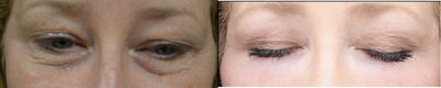 Eyelid Surgery before and after photo