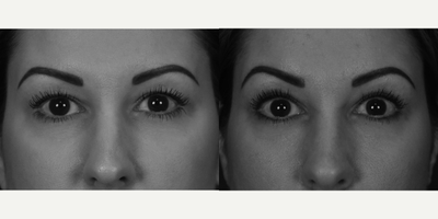 Eyelid Surgery before and after photo