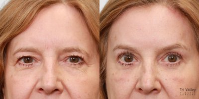 Eyelid Surgery before and after photo