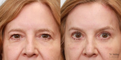Eyelid Surgery before and after photo