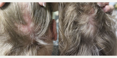 Hair Loss Treatment before and after photo