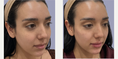 Lip Fillers before and after photo