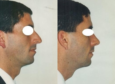 Rhinoplasty before and after photo