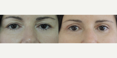 Eyelid Surgery before and after photo