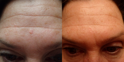 Mole Removal before and after photo