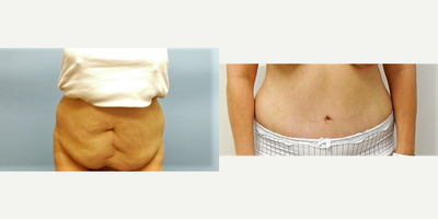Tummy Tuck before and after photo