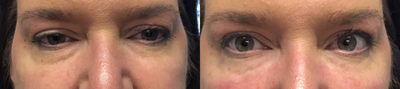 Belotero before and after photo