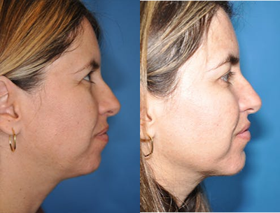 Chin Liposuction before and after photo